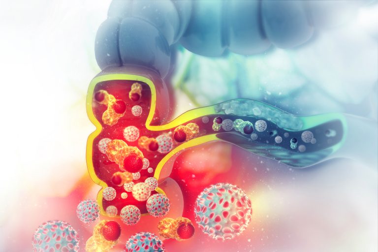 Loss of MCL1 Protein Can Drive Colorectal Cancer