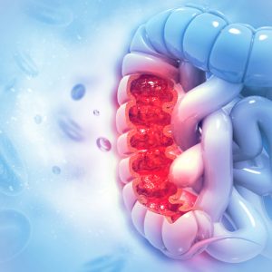 Proteogenomic Colon Cancer Analysis Offers New Diagnostic, Therapeutic Insights