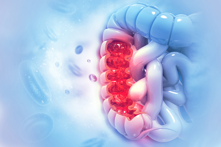 Nanoparticle Chemo Delivery Could Improve Bowel Cancer Outcomes