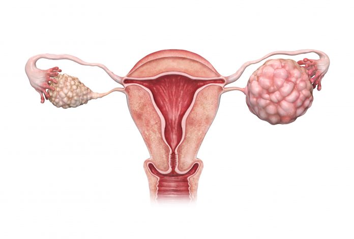 3d rendered ovarian cancer illustration.