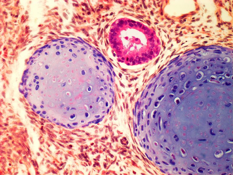 New Biomarker for Testicular Cancer-Related Autoimmune Disease