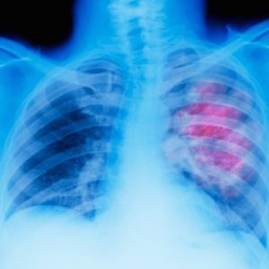 Amgen KRAS Inhibitor Shows Benefits in Lung Cancer Phase III  