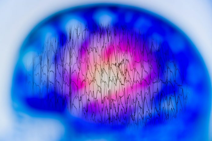 EEG with electrical activity of abnormal brain, electroencephalogram,EEG