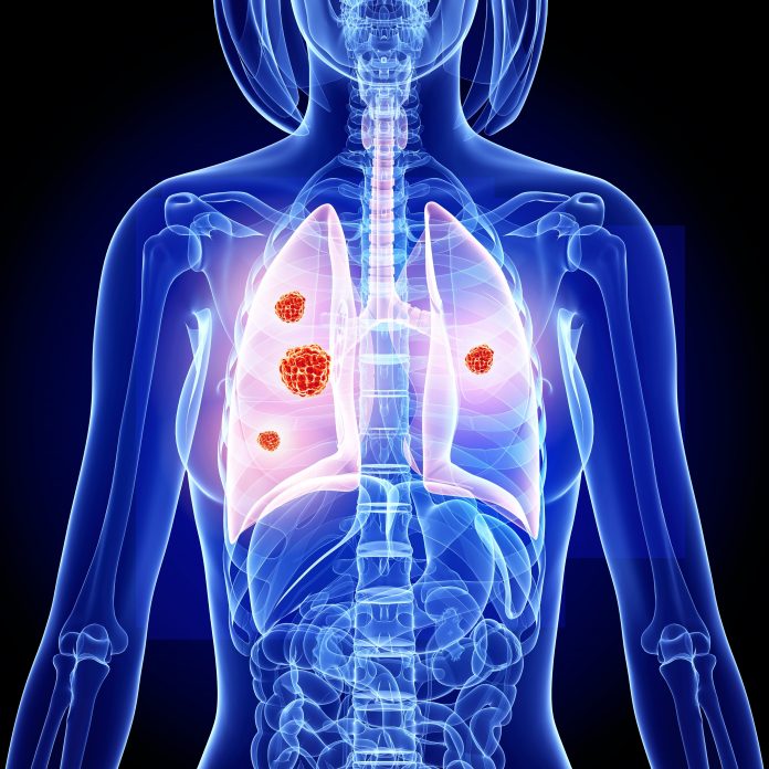 X-ray style image of the top part of a woman's body showing the lungs highlighted and four red lung cancer tumors of different sizes