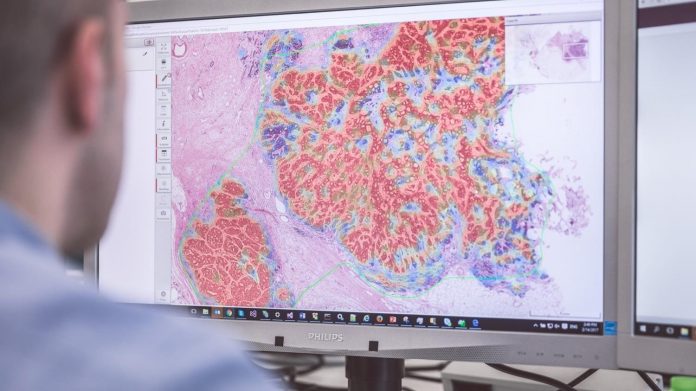 Image on screen of cancer screen. Artificial intelligence (AI) can be used in software that helps a pathologist interpret features of cancer in digitized images of samples.