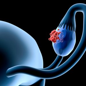 Spatial Proteomics Uncovers Ovarian Tumor Interaction with Immune System