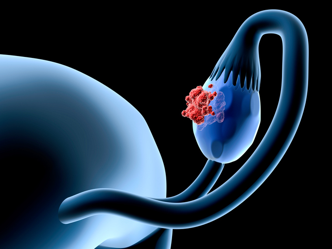 FDA Approves Myriad’s myChoice CDx for Zejula’s Late-Line Ovarian Cancer Indication
