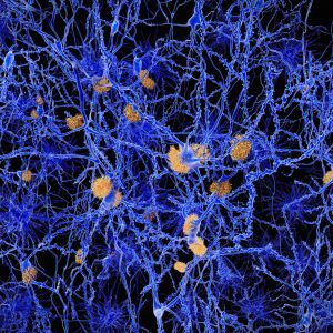 Role of Gene Tied to Alzheimer’s Disease Risk Identified