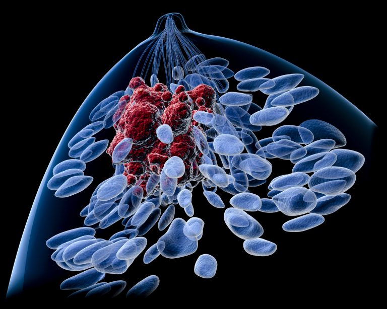 Scientists Find a New Potential Drug Class to Treat <i>FOXM1</i> Positive Breast Cancer