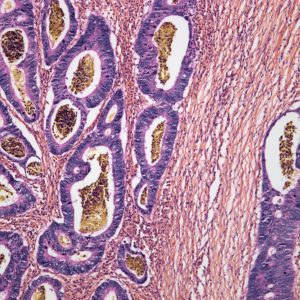 Biomarker-Informed Treatments for Gastric Cancer Patients Improve Outcomes