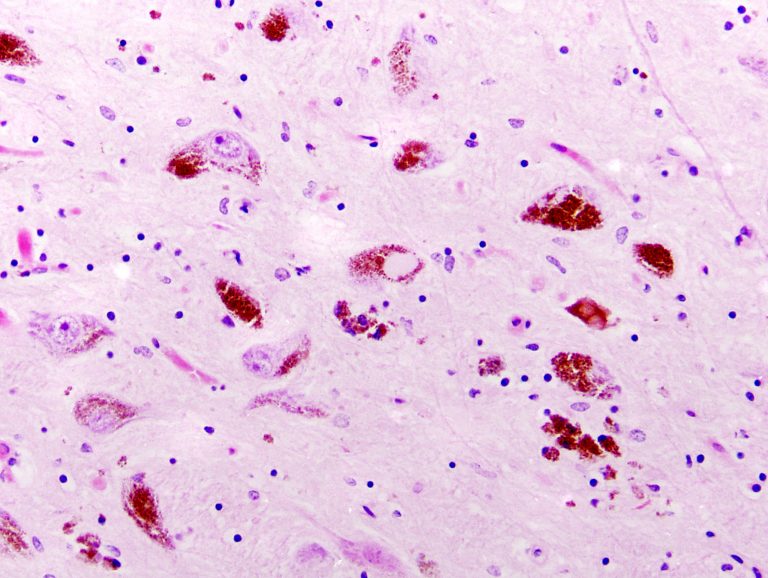 Parkinson's disease, substantia nigra, Lewy bodies