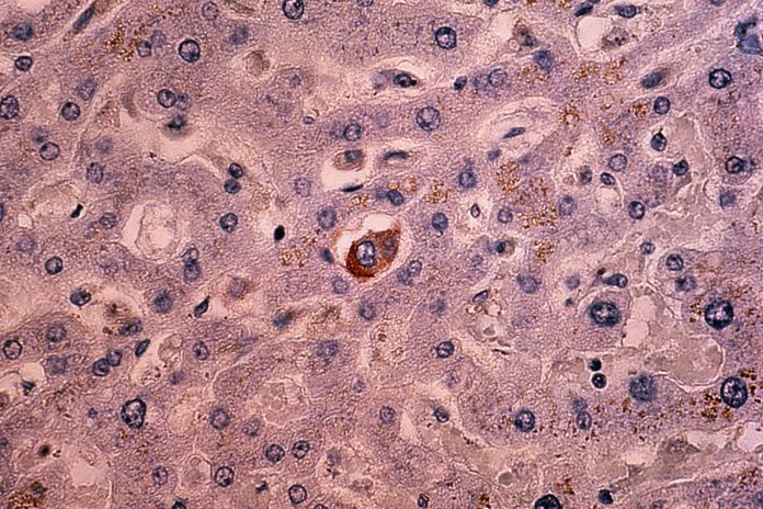 Light micrograph of metastases in breast tissue