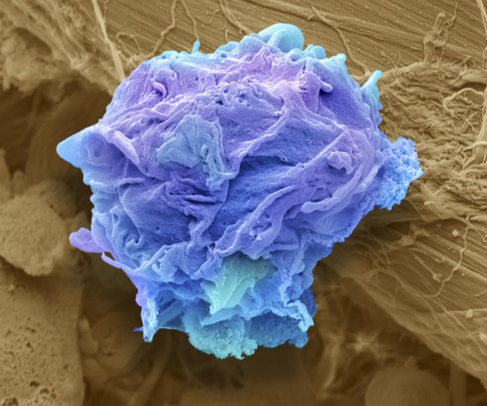 Lymphoma cancer cell that can be targeted by CAR T-cell therapy