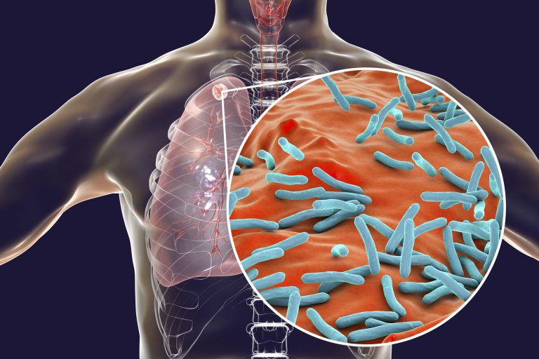 Secondary tuberculosis infection, illustration