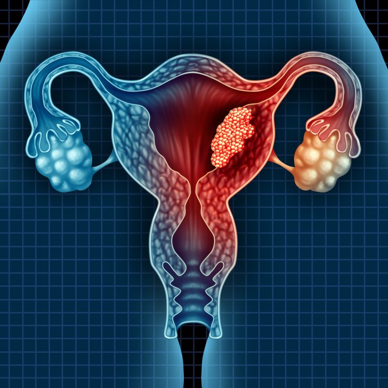 Keytruda Scores in Endometrial Cancer Trial