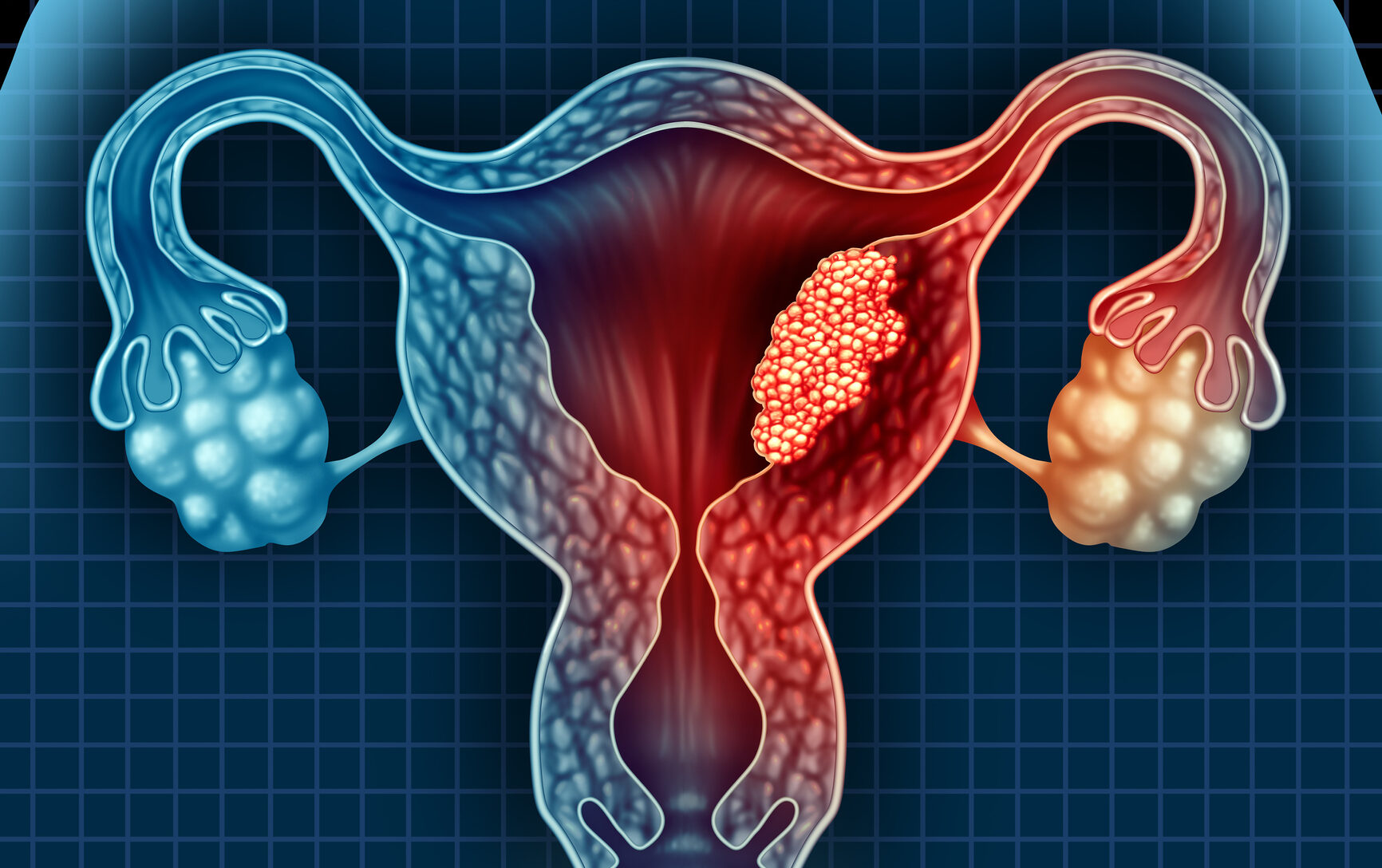Aggressive Endometrial Cancer Linked to Metabolic Activity in Visceral Fat