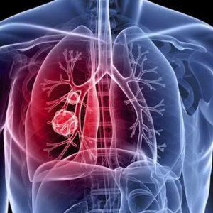 Novel Therapeutic Target Could Lead to Lung Cancer Treatments