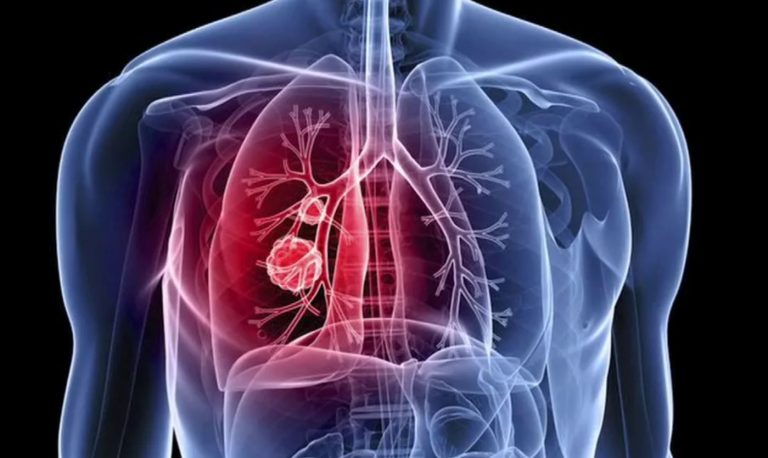 KRAS Lung Cancer Drug Reaches Clinic via Accelerated FDA Approval