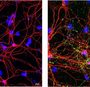 Natural Killer Cells Stop Parkinson’s Disease Progression