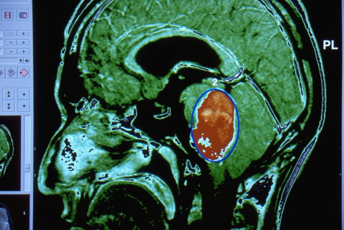 Magnetic Resonance Image of the Head, bran tumor