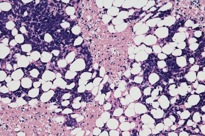 Micrographie d'un néoplasme de myélome provenant d'une biopsie de moelle osseuse