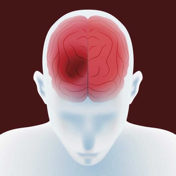 Image of a head showing the brain and an intracerebral hemorrhage or bleeding stroke