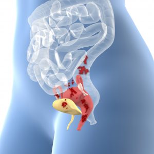 Feinstein Researchers Developing Non-Invasive Endometriosis Diagnostic