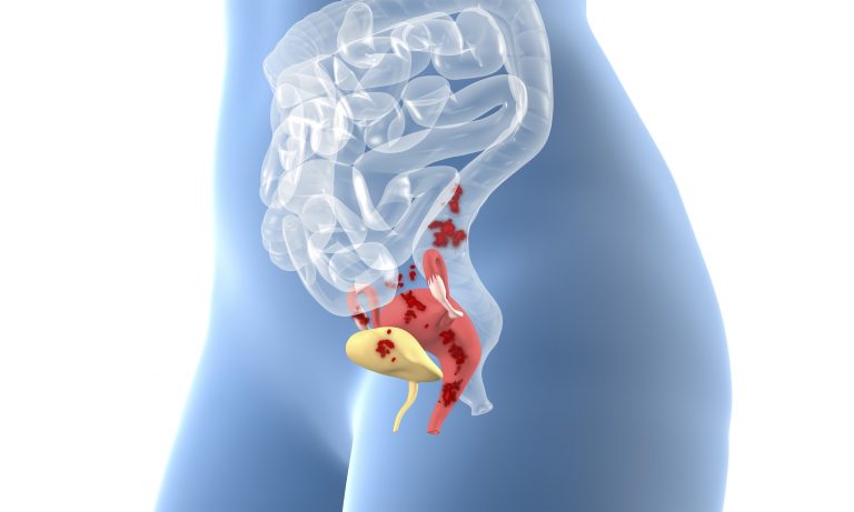 Endometriosis, 3D illustration
