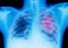 Nasal Swab Test Separates High- from Low-Risk Lung Cancer Polyps