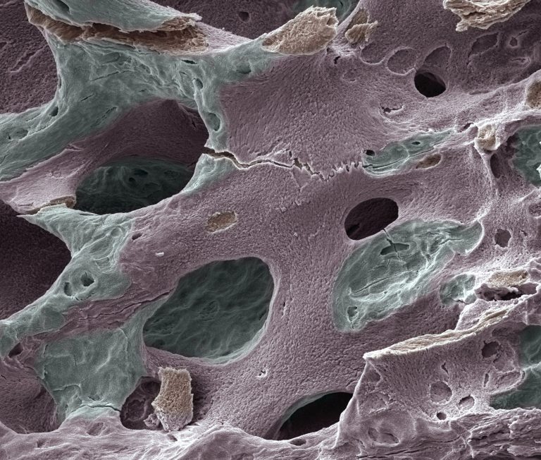 Scanning electron micrograph (SEM) of human bone, osteoporosis