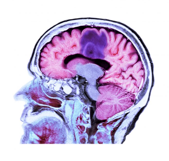 Glioblastoma brain cancer, CT scan