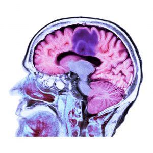 Combination Therapy against Glioblastoma Shows Promise in Animal Models