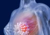 Metformin May Reduce Disease Recurrence, Death in Some HER2-Positive Breast Cancers