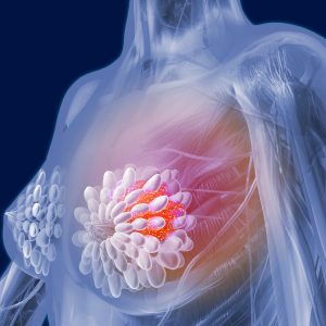 First Breast Cancer Biomarker Found for Response to Anthracycline and HER-2 Targeting Treatments