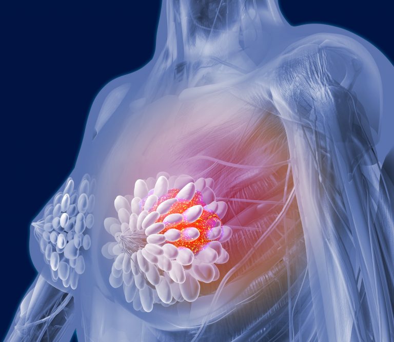 New Targets For Triple Negative Breast Cancer Therapies Uncovered