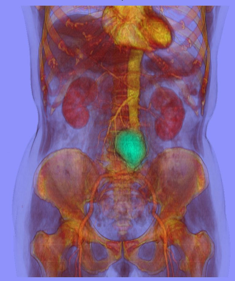 CT scan image showing an abdominal aortic aneurysm