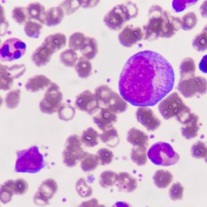 Single Cell Transcriptomics Could Help Eradicate Leukemia More Effectively