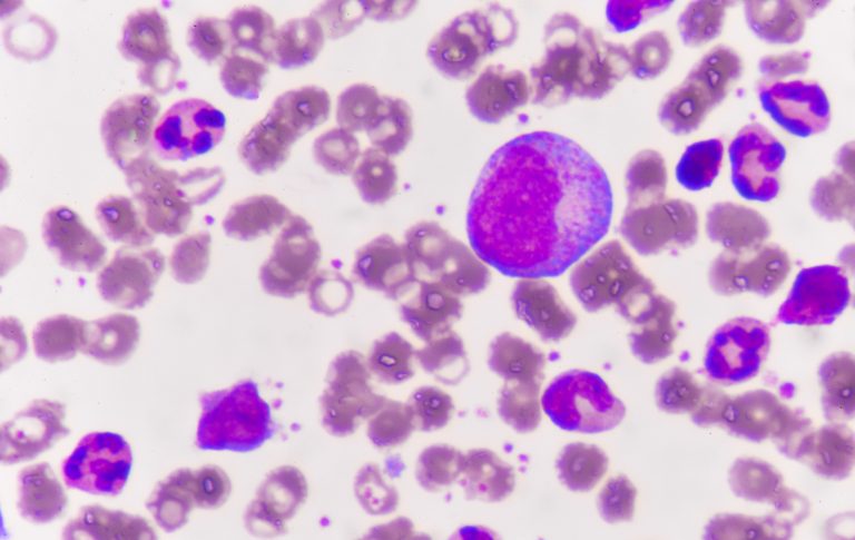 Biomarkers of CAR T-Cell Response in Pediatric Leukemia Found