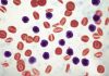 B-Cell Development Vulnerability in Leukemia Suggests Novel Combination Therapy