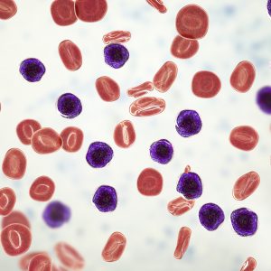 Amino Acid Plays Key Role in T Cell Acute Lymphoblastic Anemia Pathogenesis