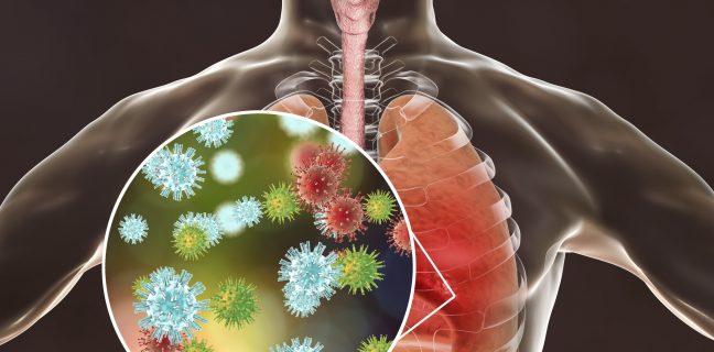 Viral pneumonia, influenza conceptual illustration