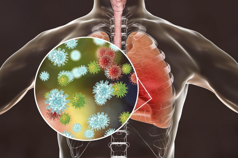 Viral pneumonia, influenza conceptual illustration