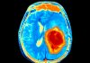 Effect of CSF on Glioblastoma Suggests Anti-Anxiety Drug Could Improve Treatment Response