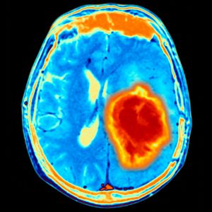New Device Detects Brain Tumors Early, from Urine