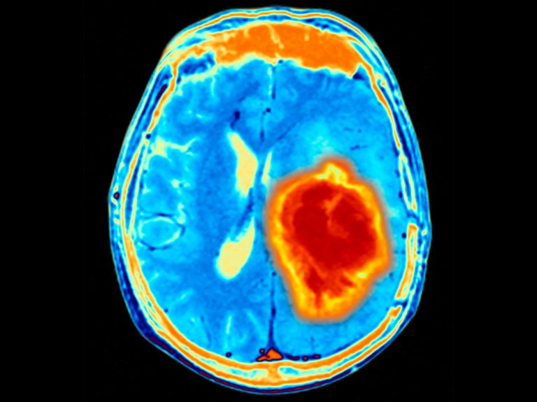 CSF Test Predicts Brain Cancer Response to Immunotherapies