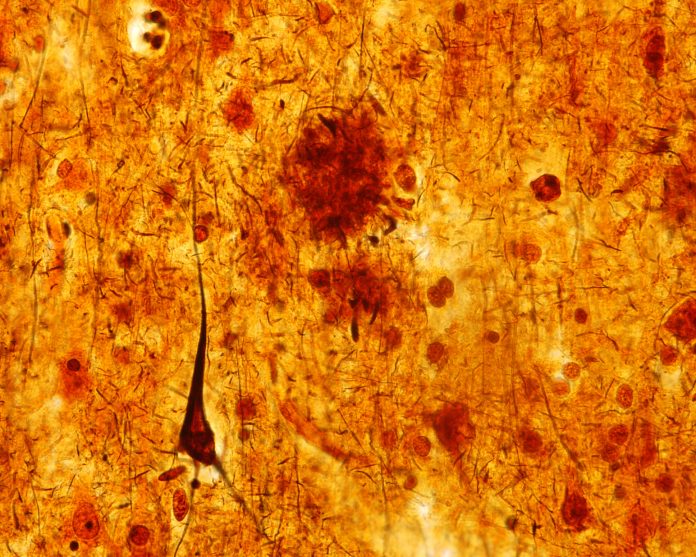 Neurofibrillary tangle.  Alzheimer's disease