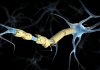 Neural Stem Cell Treatment for MS Shows Promise at Phase I