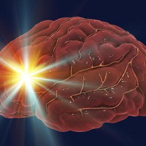 Brain Injury from Stroke Assessed by Blood-Based Biomarker