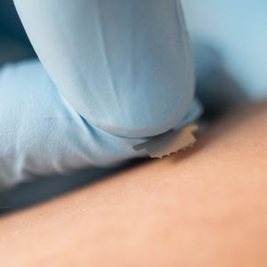 Microneedle Patch Can Extract Interstitial Fluid for Biomarker Testing