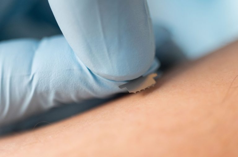 Microneedle Patch Can Extract Interstitial Fluid for Biomarker Testing